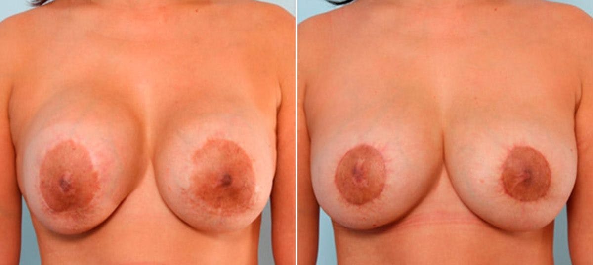 Breast Revision with Strattice Before & After Photo - Patient 54883355 - Image 1