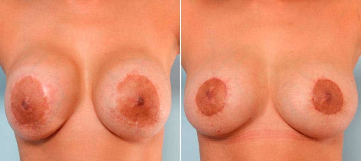 Breast Revision with Strattice Before & After Photo - Patient 54883355 - Image 2