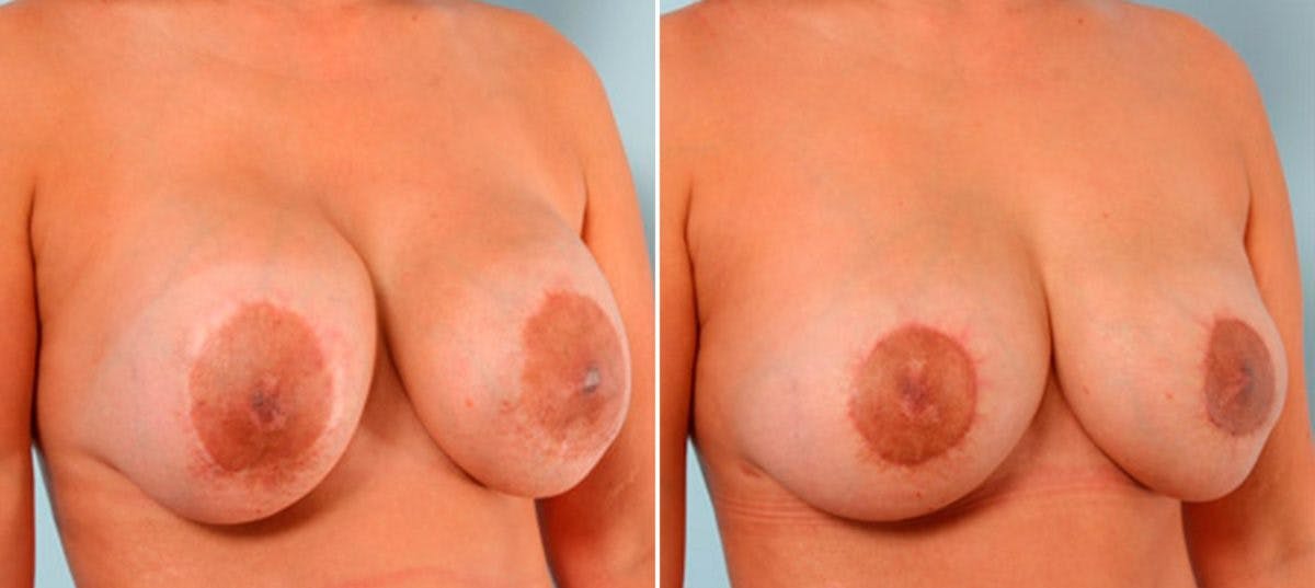 Breast Revision with Strattice Before & After Photo - Patient 54883355 - Image 3