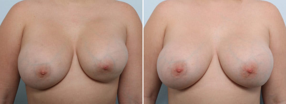 Breast Revision with Strattice Before & After Gallery - Patient 54883358 - Image 1