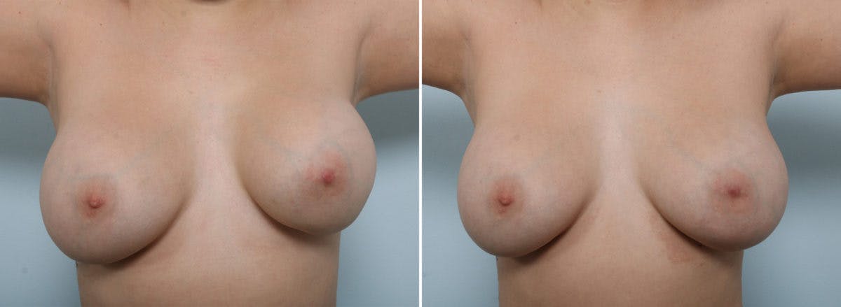 Breast Revision with Strattice Before & After Gallery - Patient 54883358 - Image 2