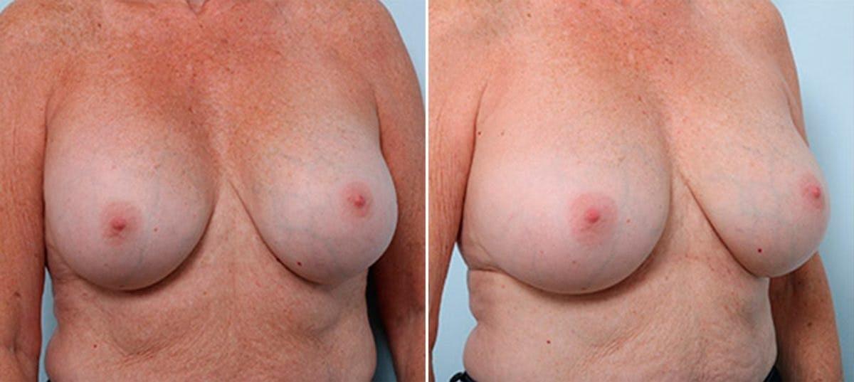 Breast Revision with Strattice Before & After Gallery - Patient 54883362 - Image 2
