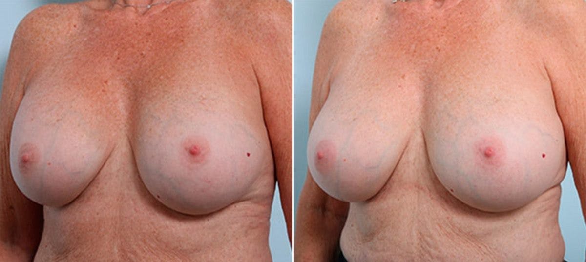Breast Revision with Strattice Before & After Gallery - Patient 54883362 - Image 4