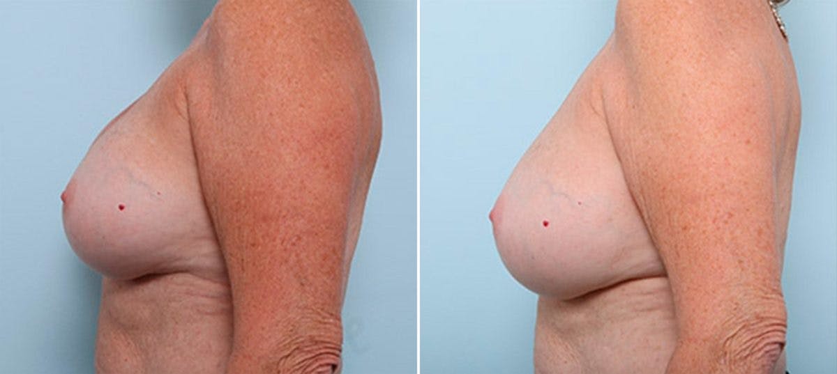 Breast Revision with Strattice Before & After Gallery - Patient 54883362 - Image 5