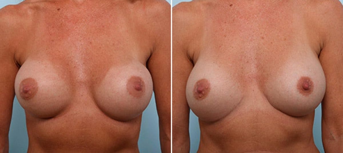 Breast Revision with Strattice Before & After Gallery - Patient 54883369 - Image 1