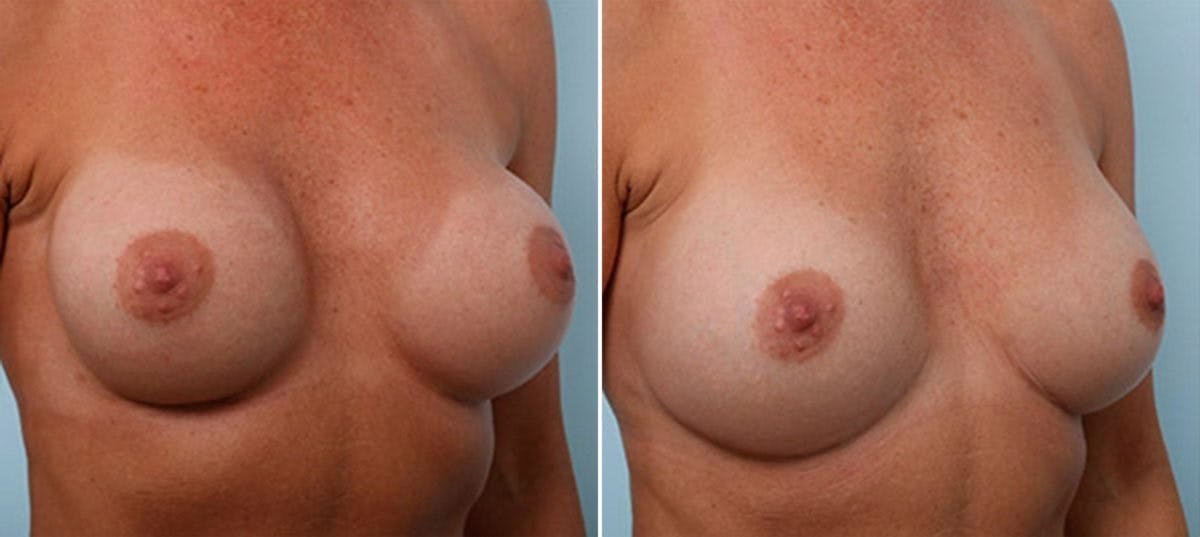 Breast Revision with Strattice Before & After Gallery - Patient 54883369 - Image 2