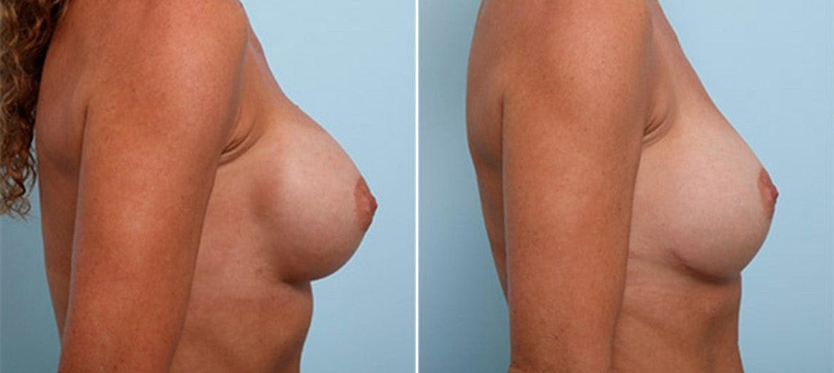 Breast Revision with Strattice Before & After Gallery - Patient 54883369 - Image 3