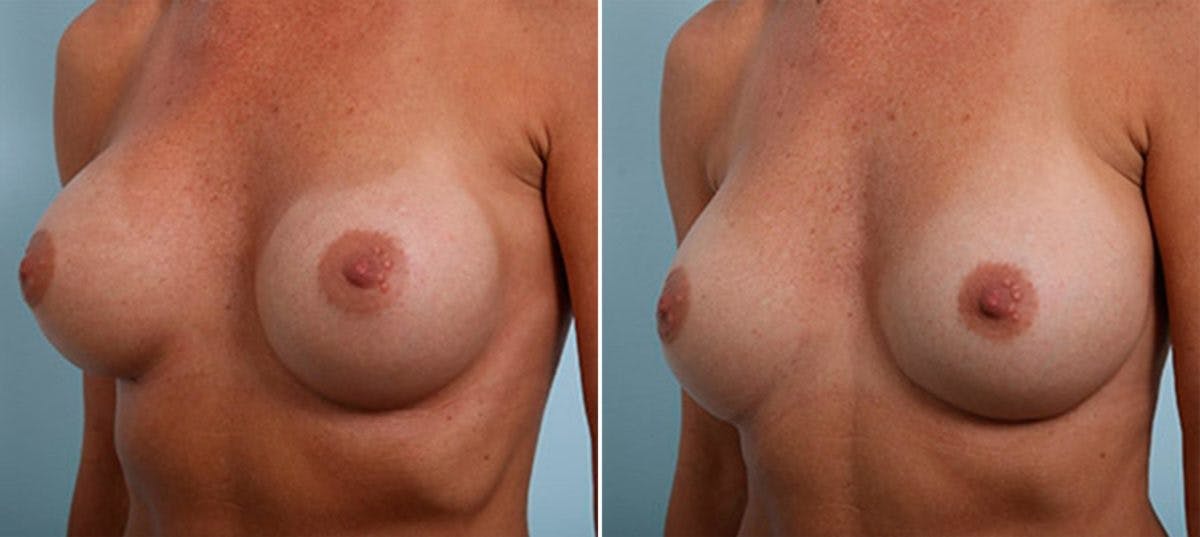 Breast Revision with Strattice Before & After Gallery - Patient 54883369 - Image 4