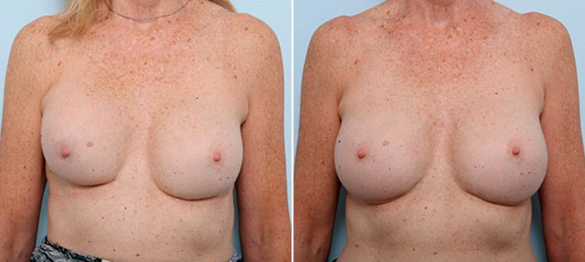 Breast Revision with Strattice Before & After Gallery - Patient 54883371 - Image 1