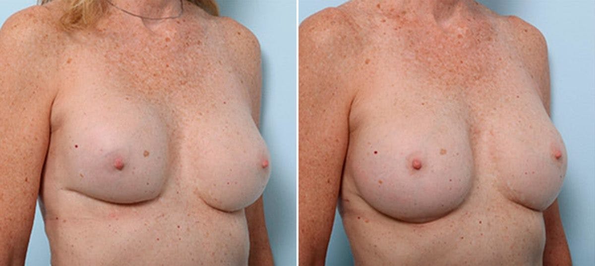 Breast Revision with Strattice Before & After Gallery - Patient 54883371 - Image 2