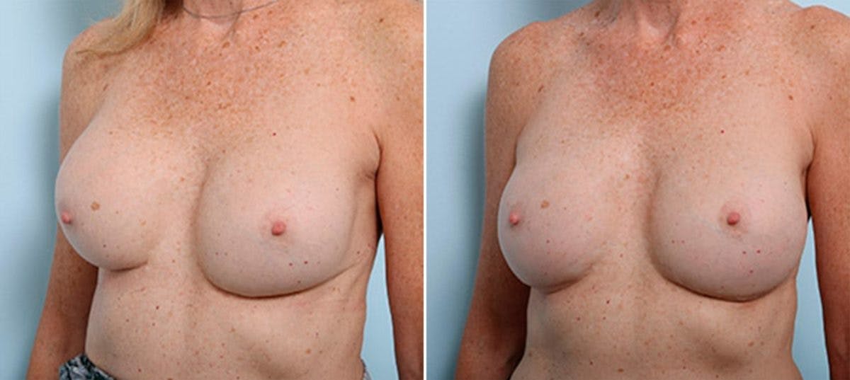 Breast Revision with Strattice Before & After Gallery - Patient 54883371 - Image 4