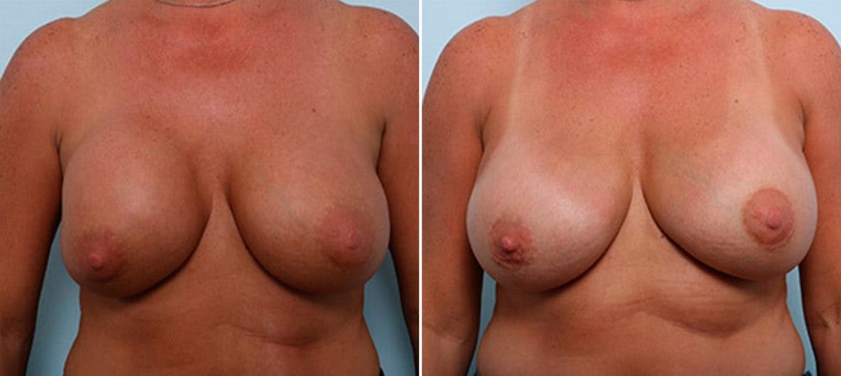 Breast Revision with Strattice Before & After Gallery - Patient 54883373 - Image 1