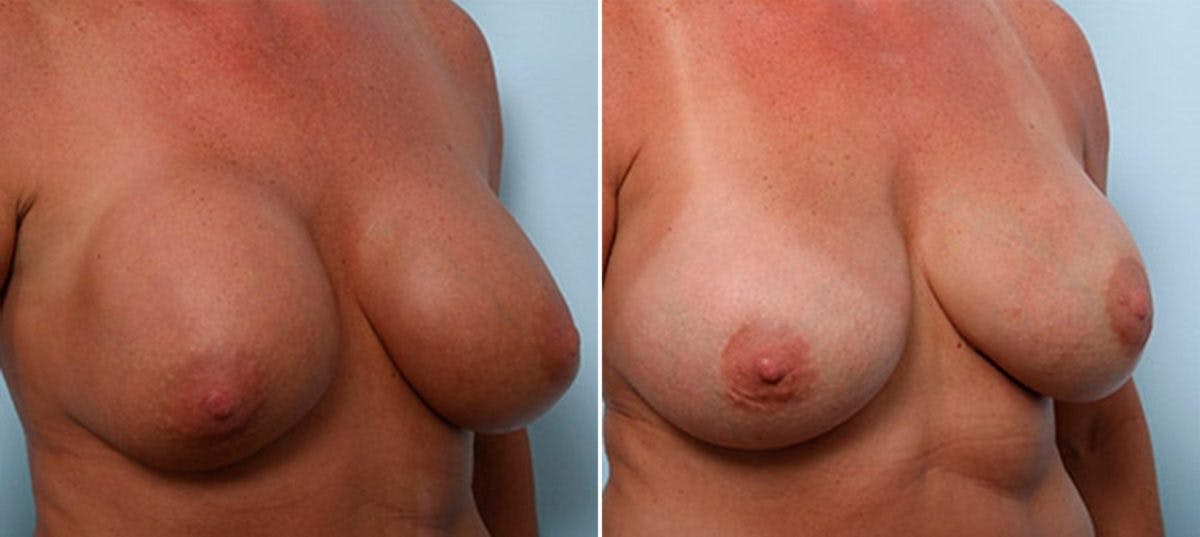 Breast Revision with Strattice Before & After Gallery - Patient 54883373 - Image 2