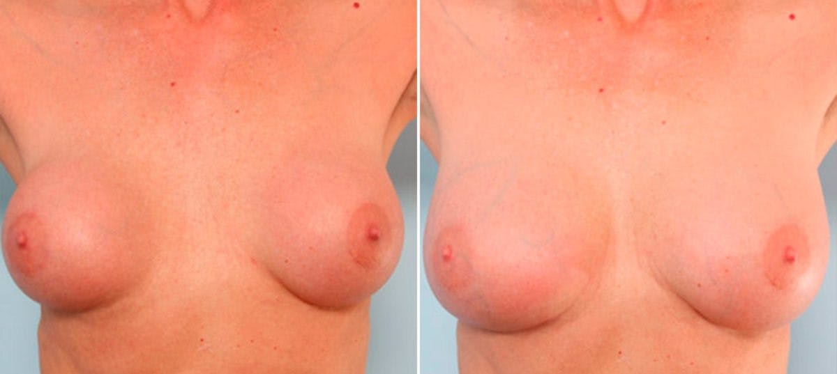 Breast Revision with Strattice Before & After Photo - Patient 54883375 - Image 2