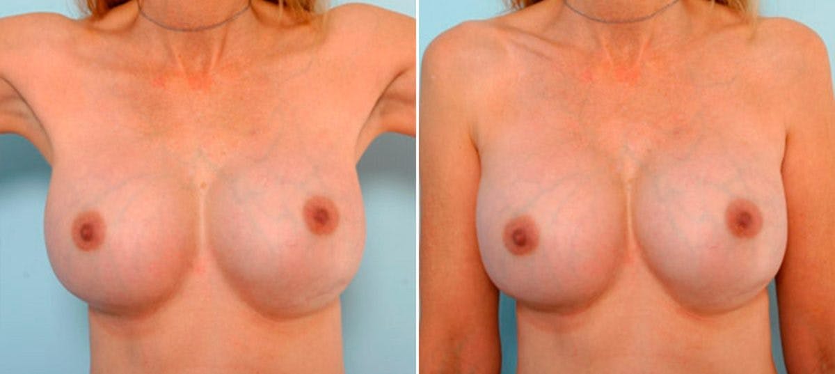 Breast Revision with Strattice Before & After Photo - Patient 54883378 - Image 2