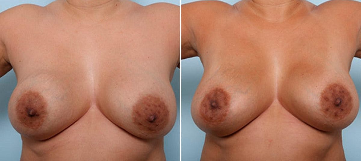 Breast Revision with Strattice Before & After Photo - Patient 54883391 - Image 1