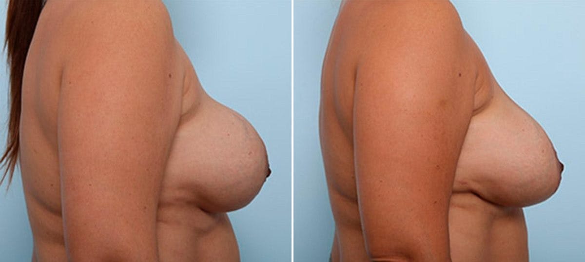 Breast Revision with Strattice Before & After Photo - Patient 54883391 - Image 3