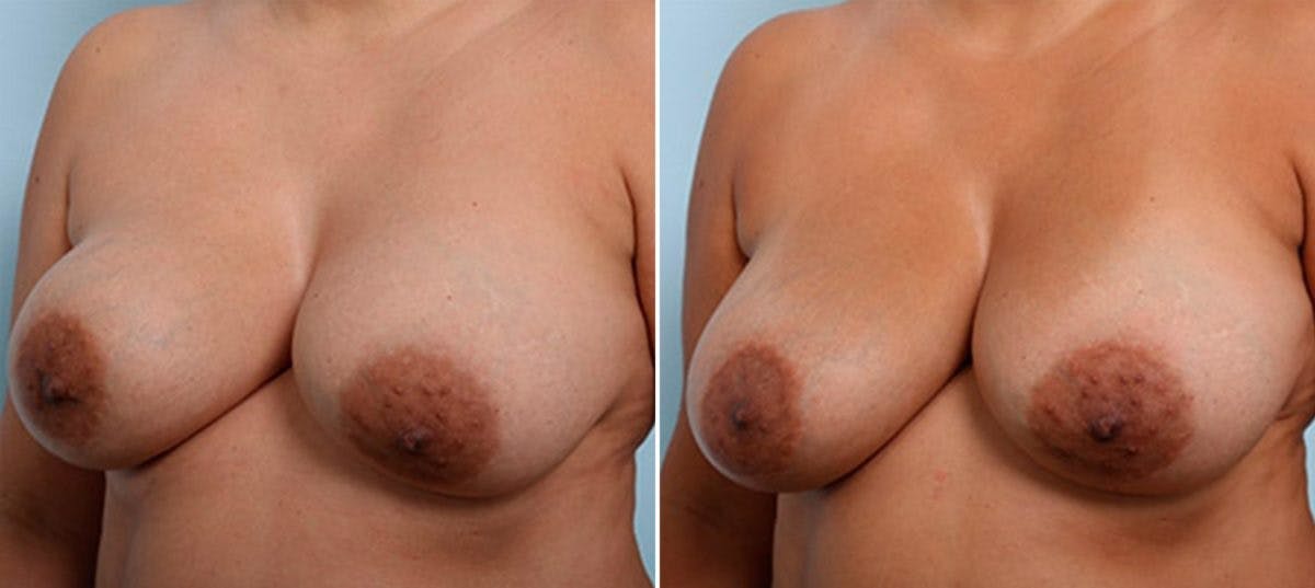 Breast Revision with Strattice Before & After Photo - Patient 54883391 - Image 4