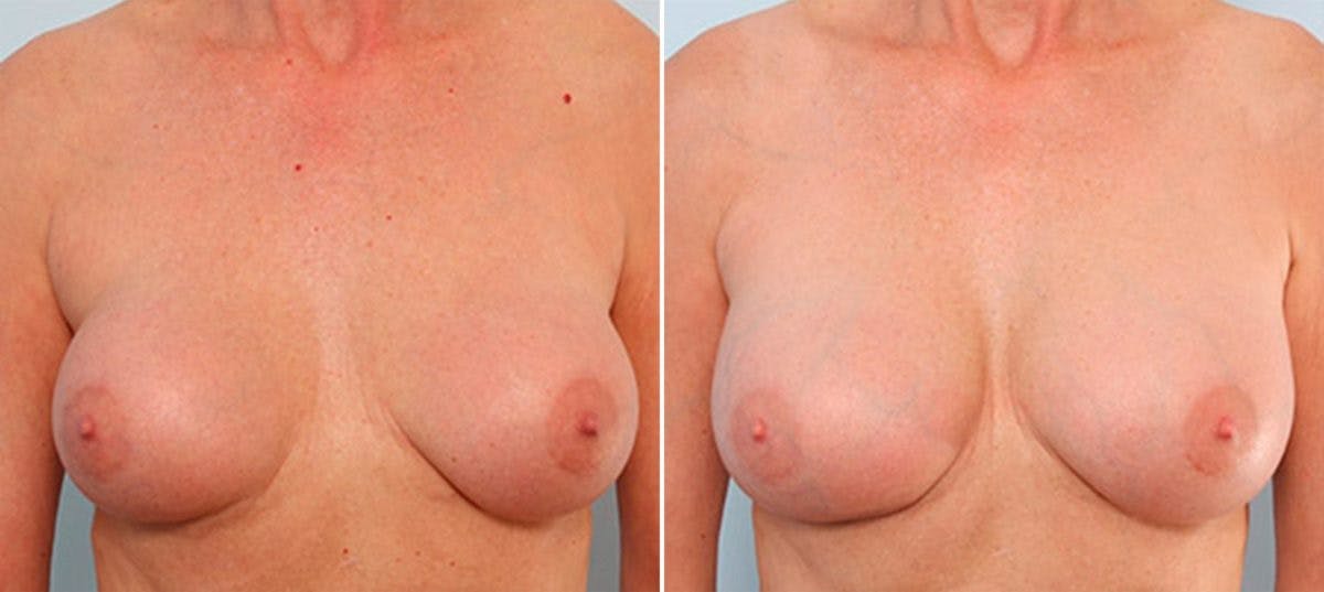 Breast Revision with Strattice Before & After Gallery - Patient 54883393 - Image 1