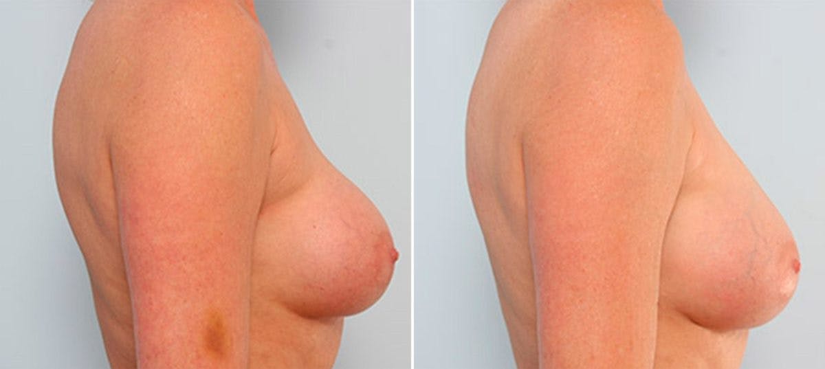 Breast Revision with Strattice Before & After Gallery - Patient 54883393 - Image 3