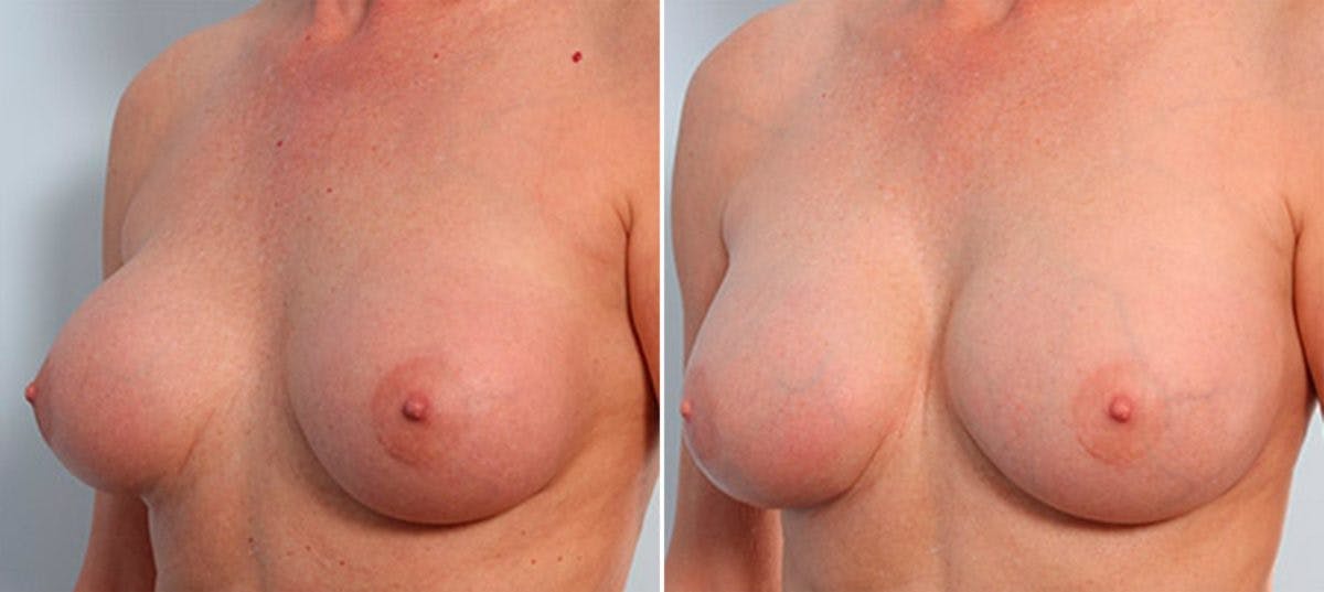 Breast Revision with Strattice Before & After Gallery - Patient 54883393 - Image 4