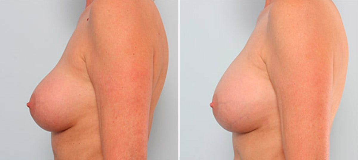 Breast Revision with Strattice Before & After Gallery - Patient 54883393 - Image 5