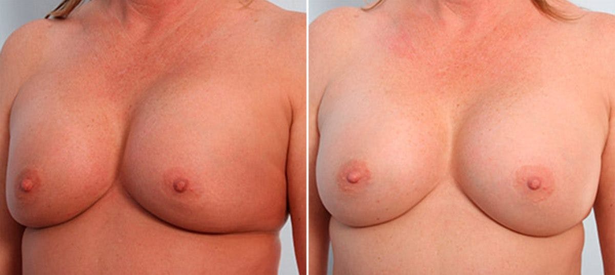 Breast Revision with Strattice Before & After Gallery - Patient 54883399 - Image 4