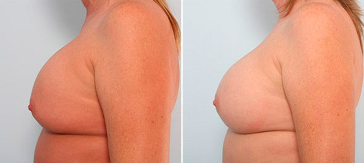 Breast Revision with Strattice Before & After Gallery - Patient 54883399 - Image 5