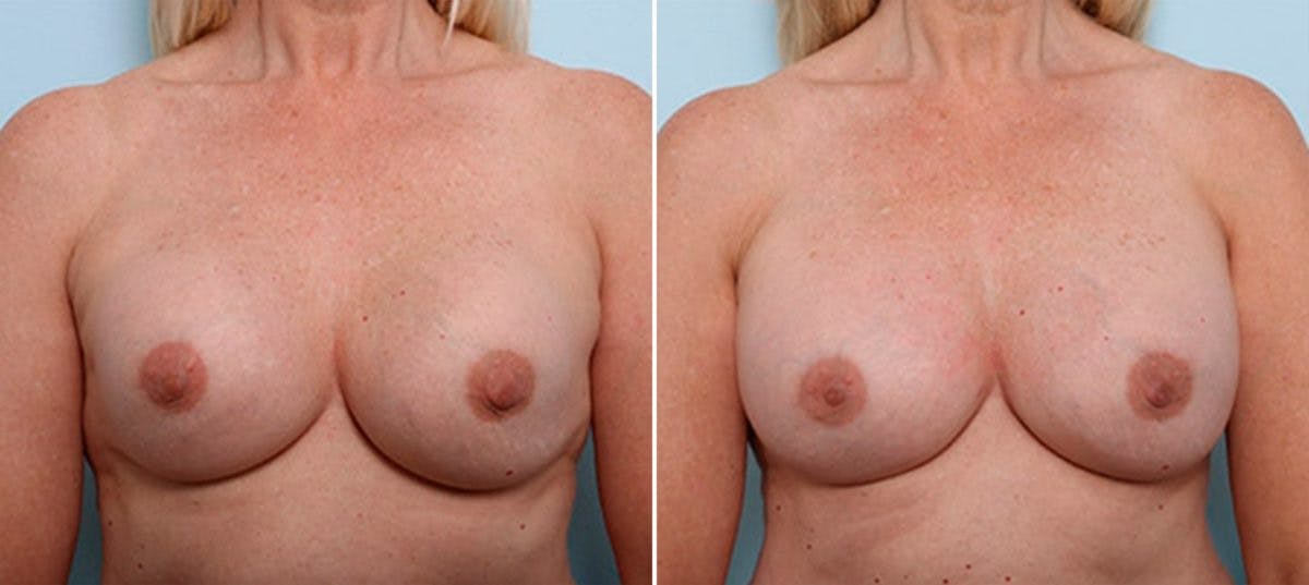 Breast Revision with Strattice Before & After Gallery - Patient 54883471 - Image 1