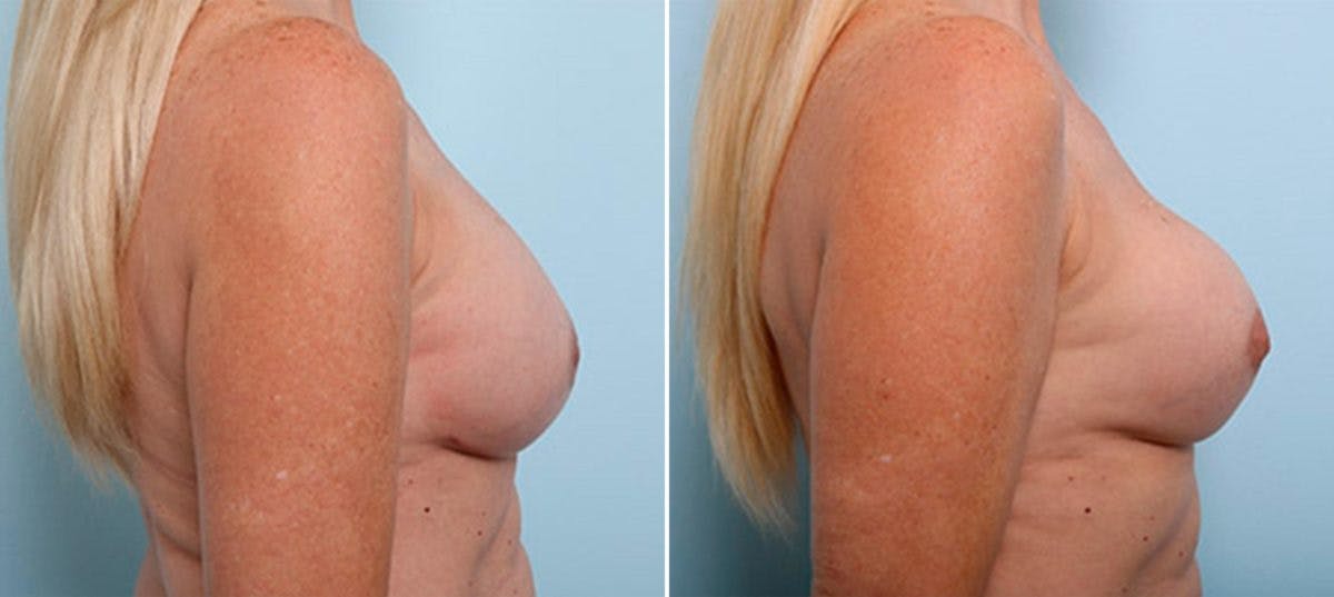 Breast Revision with Strattice Before & After Photo - Patient 54883471 - Image 3