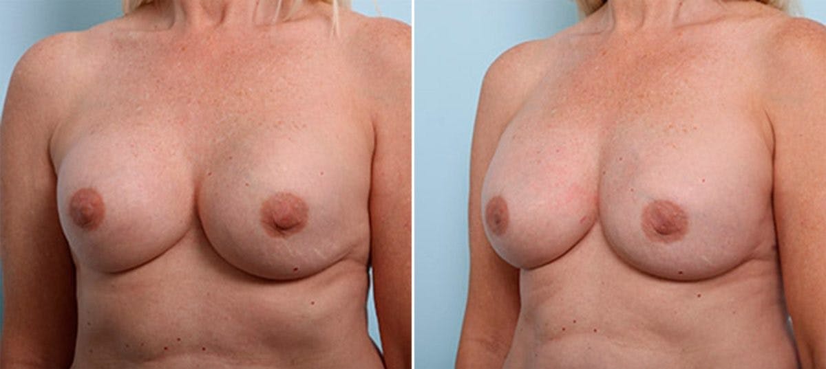 Breast Revision with Strattice Before & After Photo - Patient 54883471 - Image 4