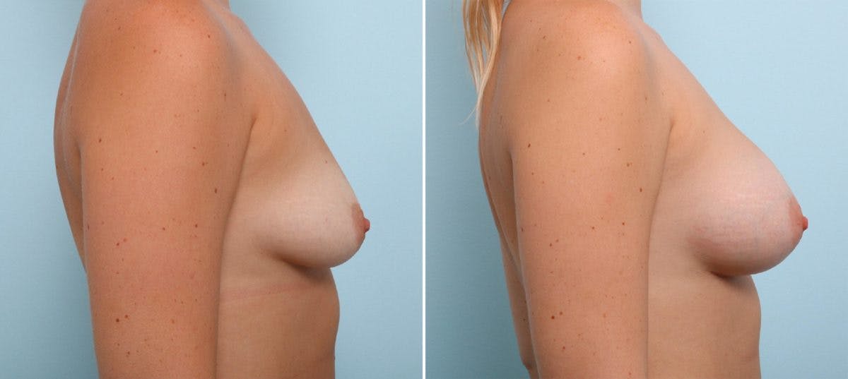 Breast Augmentation Before & After Gallery - Patient 54883873 - Image 3