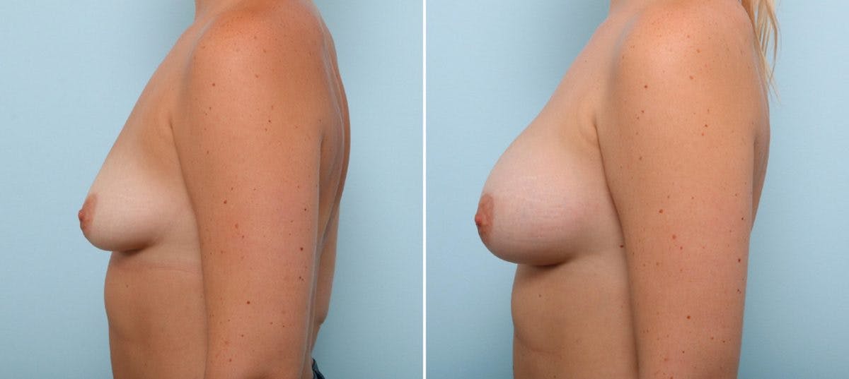 Breast Augmentation Before & After Gallery - Patient 54883873 - Image 5