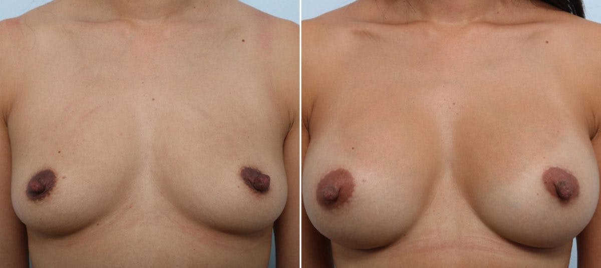 Breast Augmentation Before & After Photo - Patient 54883875 - Image 1