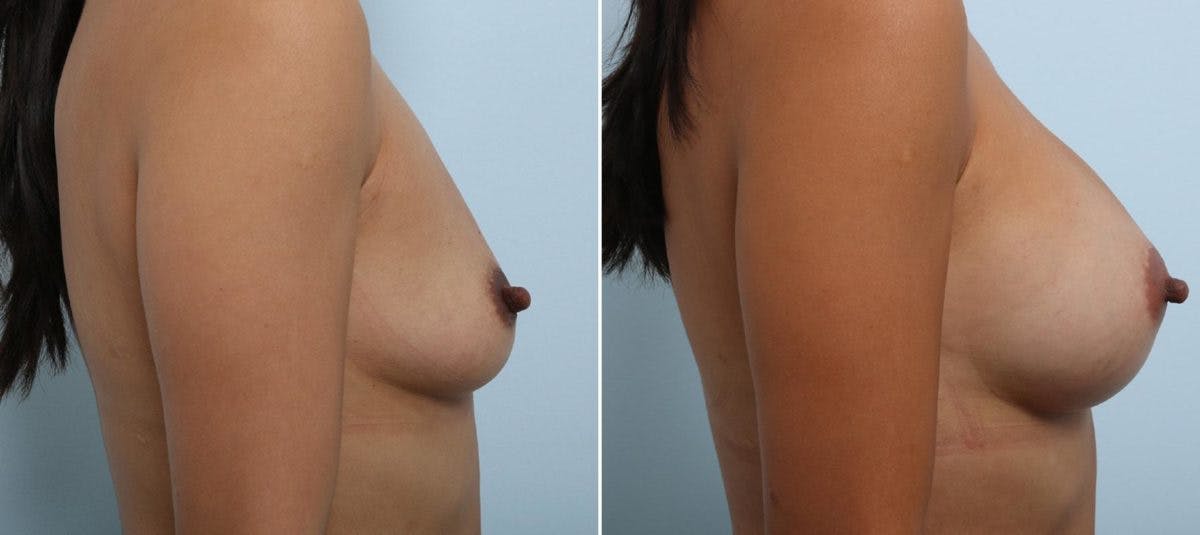 Breast Augmentation Before & After Photo - Patient 54883875 - Image 3