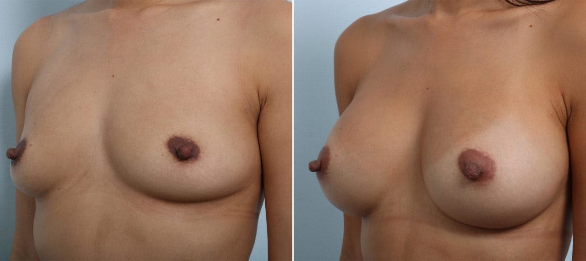 Breast Augmentation Before & After Gallery - Patient 54883875 - Image 4