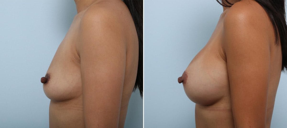 Breast Augmentation Before & After Gallery - Patient 54883875 - Image 5