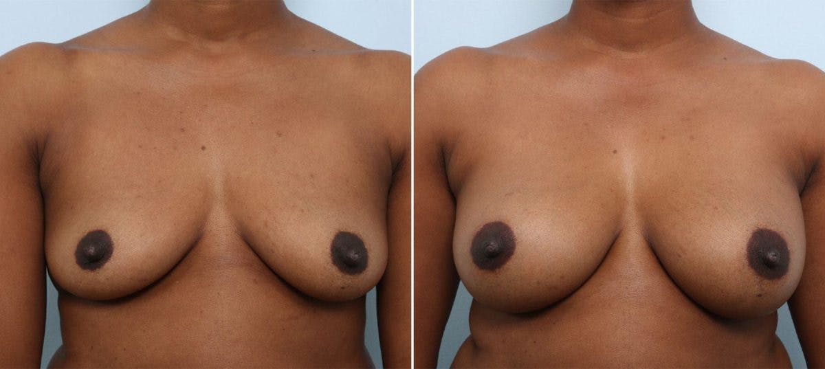 Breast Augmentation Before & After Photo - Patient 54883876 - Image 1