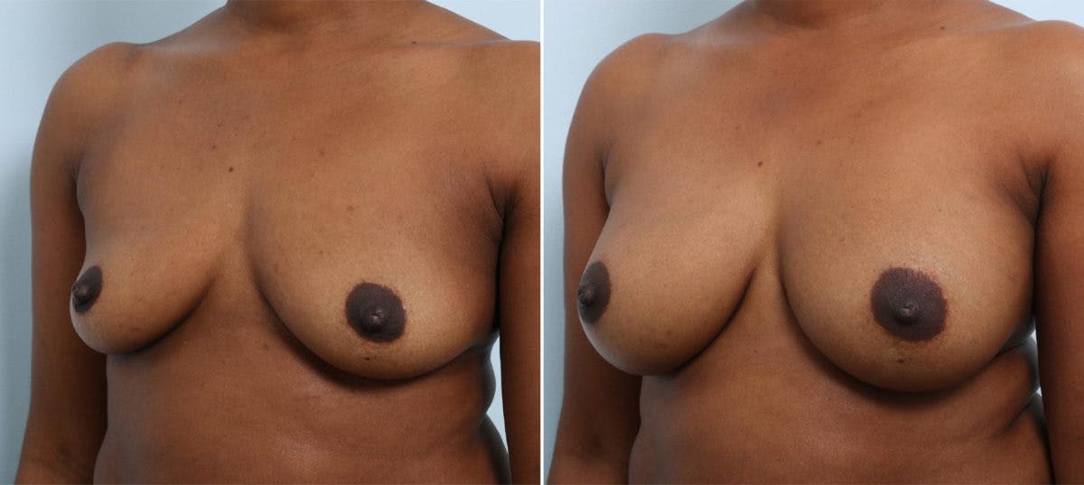 Breast Augmentation Before & After Gallery - Patient 54883876 - Image 4