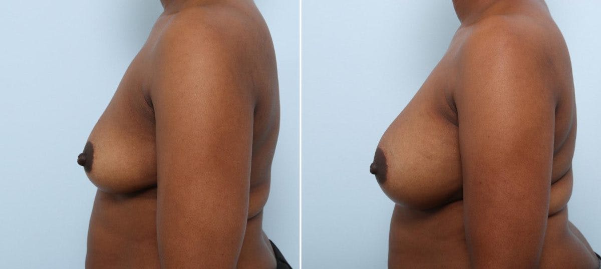 Breast Augmentation Before & After Gallery - Patient 54883876 - Image 5