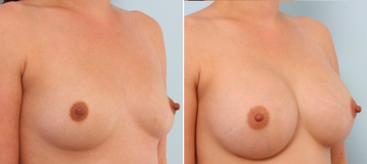 Breast Augmentation Before & After Gallery - Patient 54883877 - Image 2