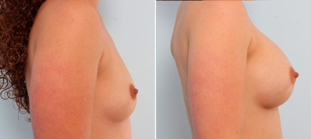 Breast Augmentation Before & After Gallery - Patient 54883877 - Image 4