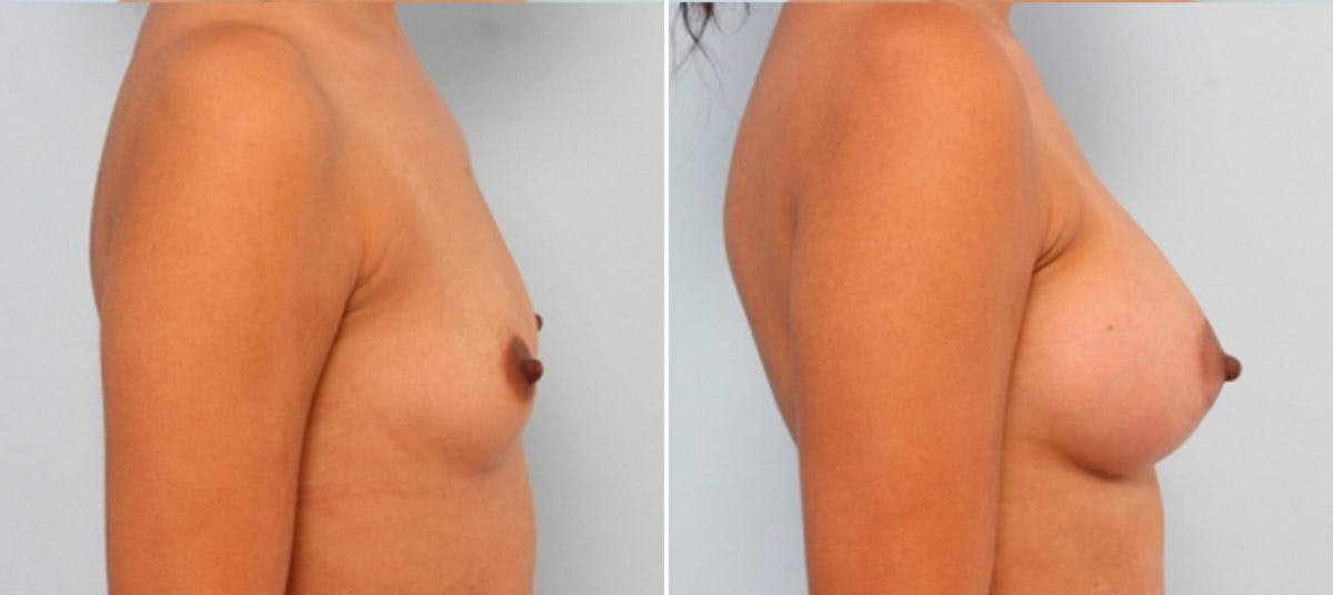 Breast Augmentation Before & After Gallery - Patient 54883885 - Image 3