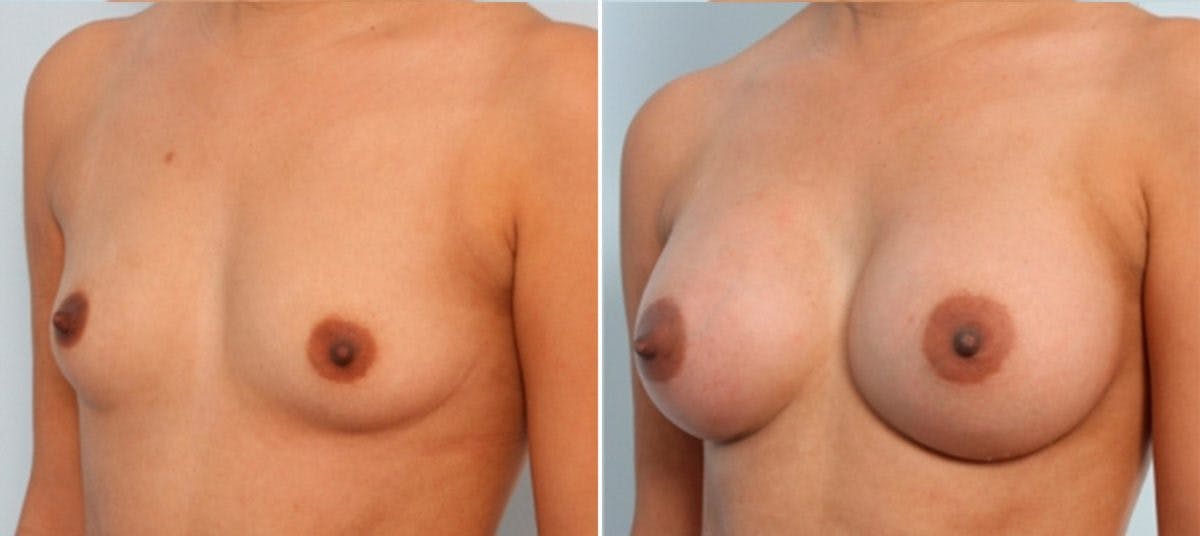 Breast Augmentation Before & After Gallery - Patient 54883885 - Image 4
