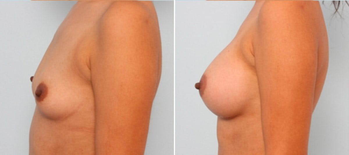 Breast Augmentation Before & After Gallery - Patient 54883885 - Image 5