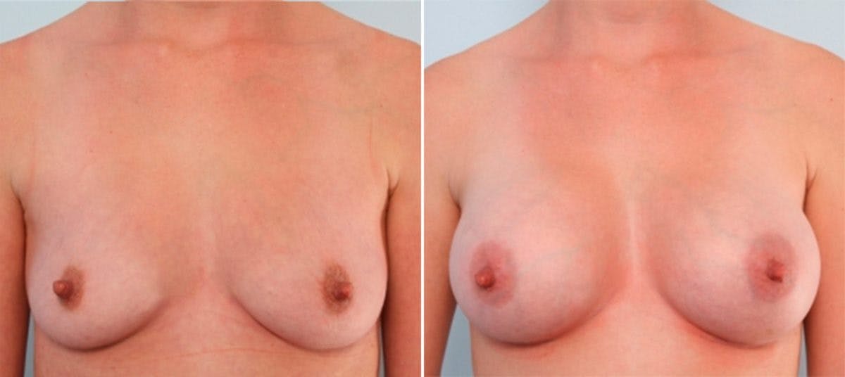 Breast Augmentation Before & After Gallery - Patient 54883886 - Image 1