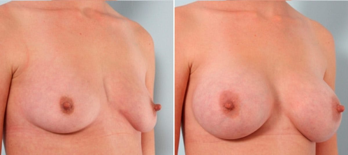 Breast Augmentation Before & After Gallery - Patient 54883886 - Image 2