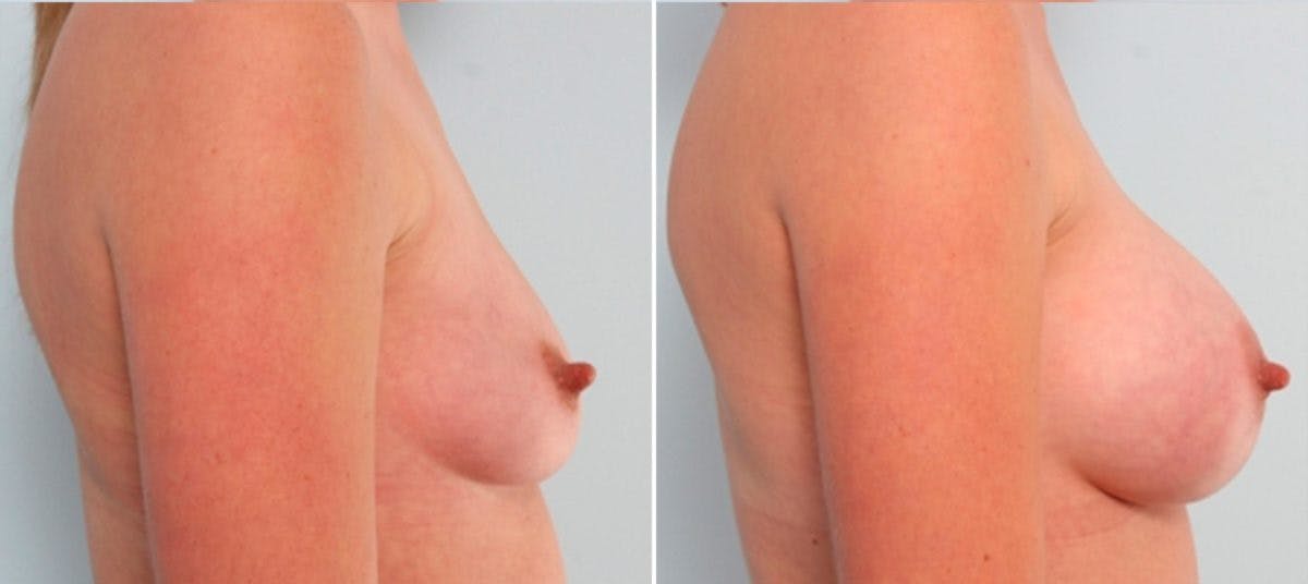 Breast Augmentation Before & After Gallery - Patient 54883886 - Image 4