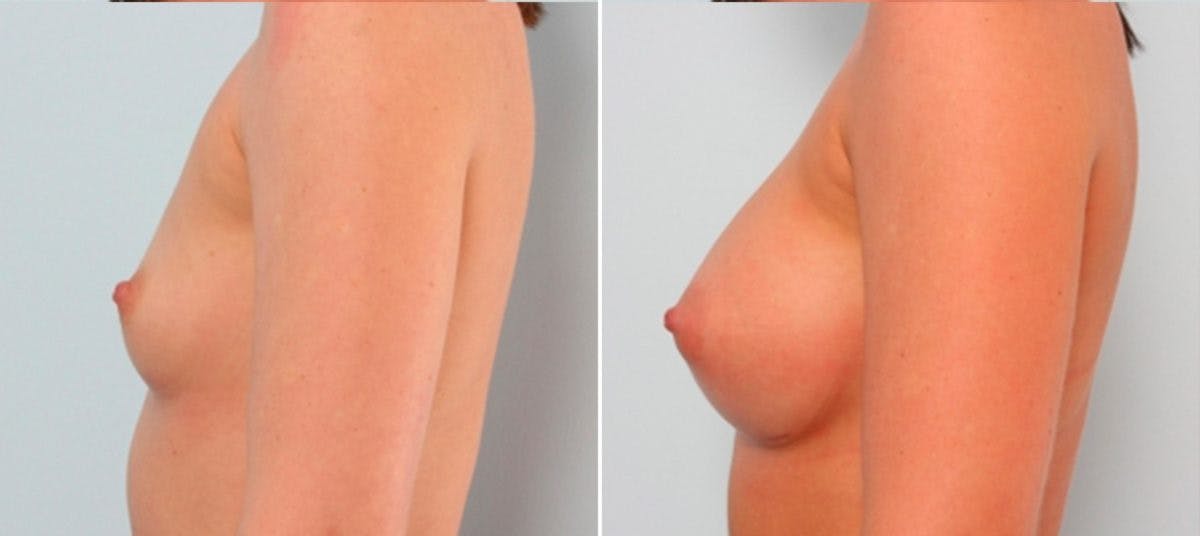 Breast Augmentation Before & After Gallery - Patient 54883891 - Image 5