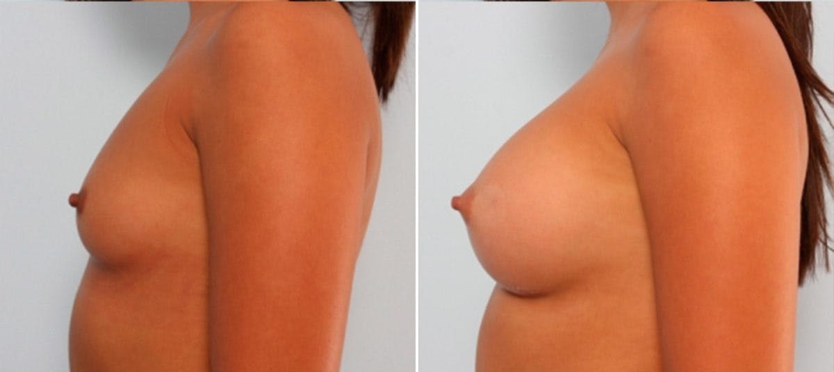 Breast Augmentation Before & After Gallery - Patient 54883901 - Image 5